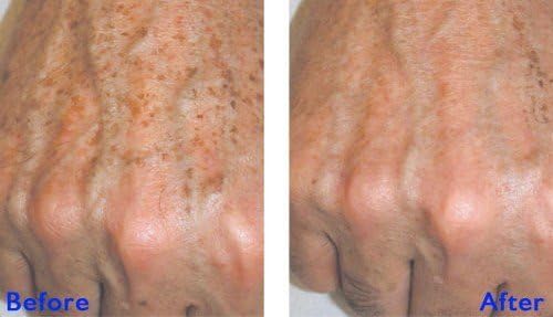 True Radiance JESSNER Peel 1 oz - Exfoliating Chemical Peel for Skin Resurfacing, Collagen Production & Hyperpigmentation Removal