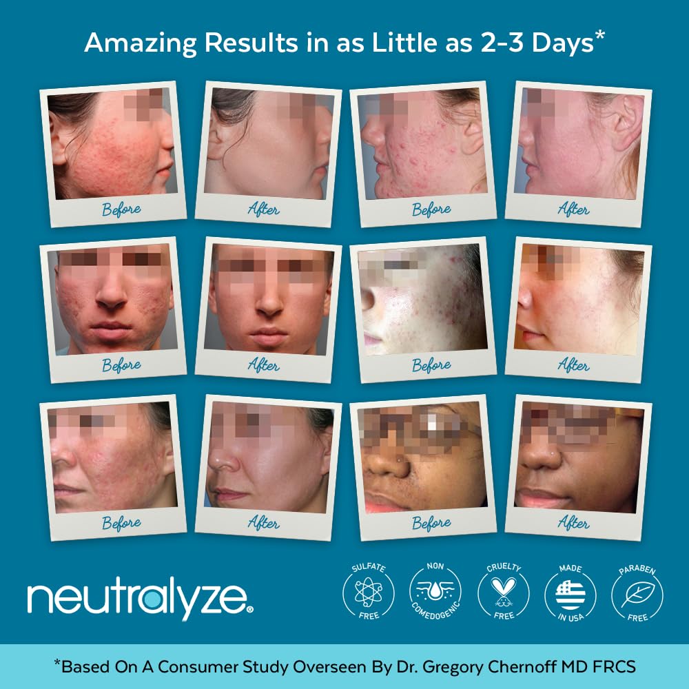 Neutralyze Moderate To Severe Acne Treatment Kit 2.0 - Maximum Strength Acne Kit, 2% Salicylic Acid, 2% Mandelic Acid & Nitrogen
