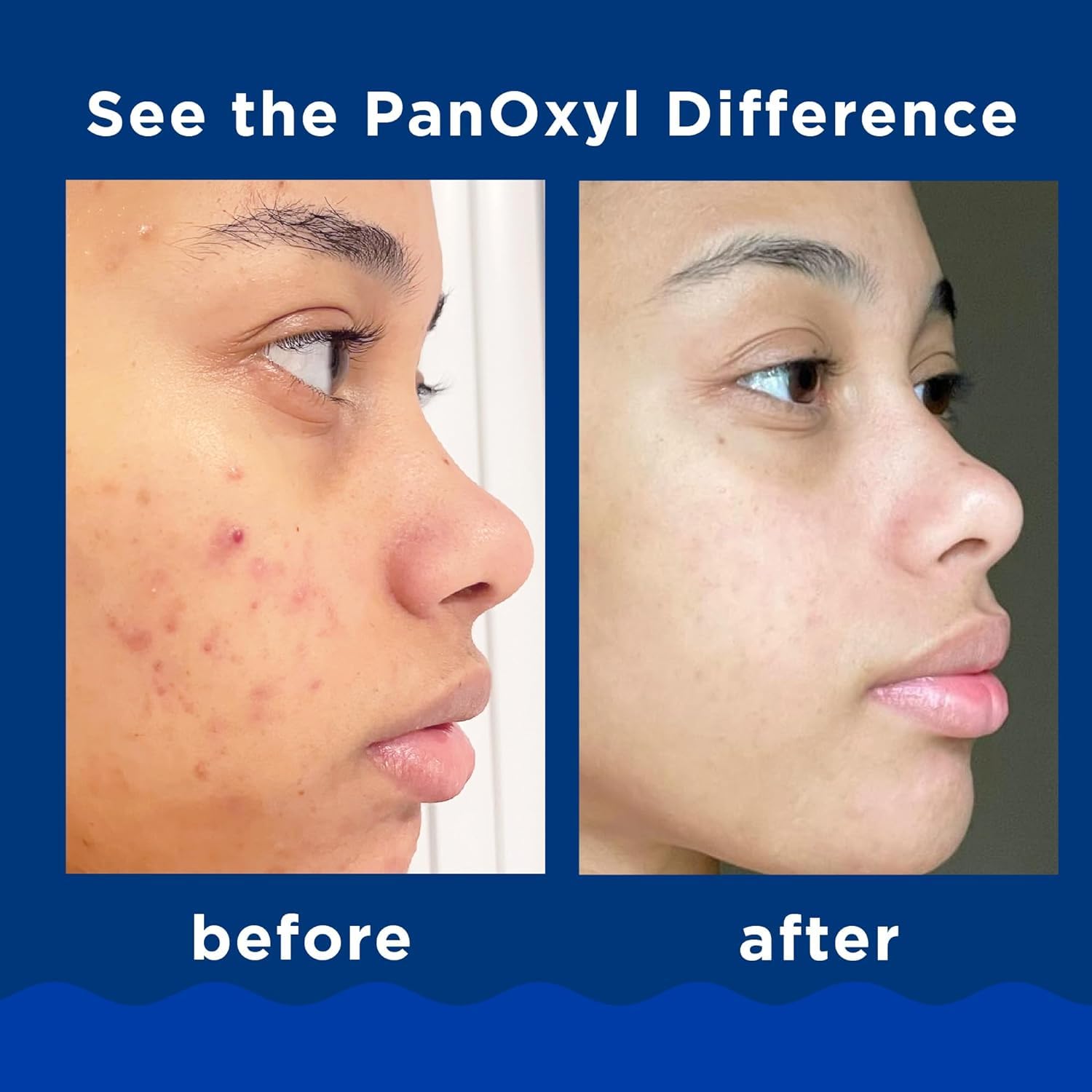 Panoxyl Acne Foaming Wash 10% Benzoyl Peroxide 5.5 Ounces