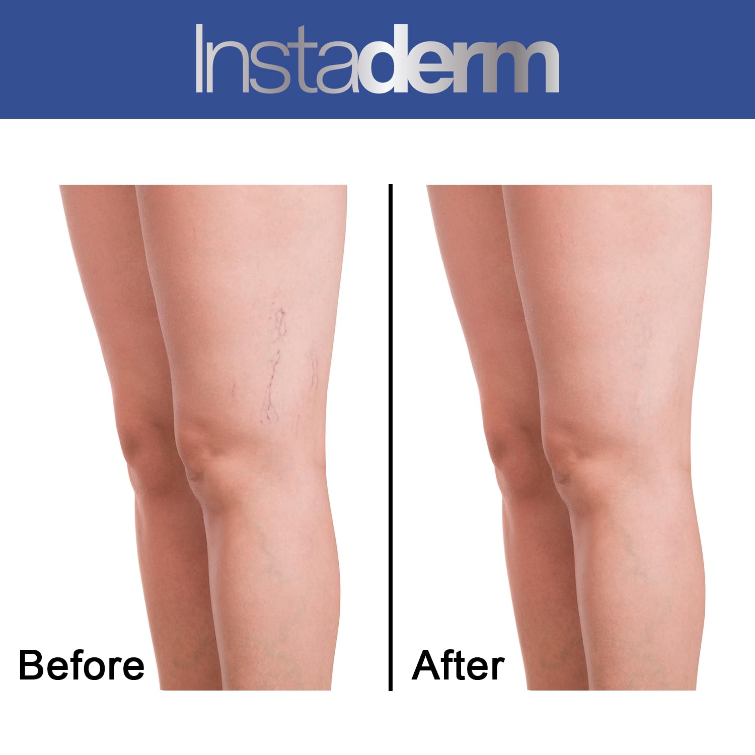 Instaderm Vitamin K Cream- Bruise Healing Formula With Arnica. Dark Spot Moisturizer For Bruising, Spider Veins & Broken Capilla