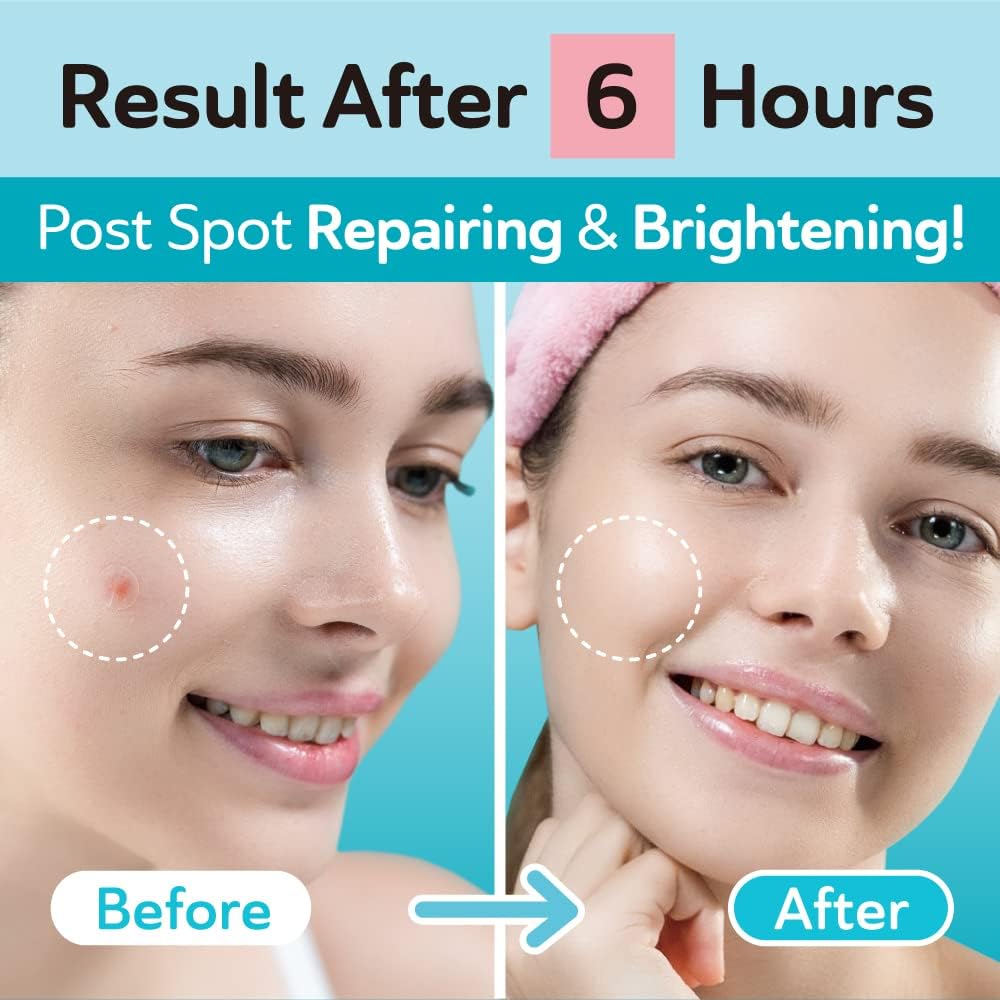 Derma Angel Acne Patches For Face Ultra Invisible Pimple Patches For Face Hydrocolloid Patches Zit Patches Acne Stickers Exposed