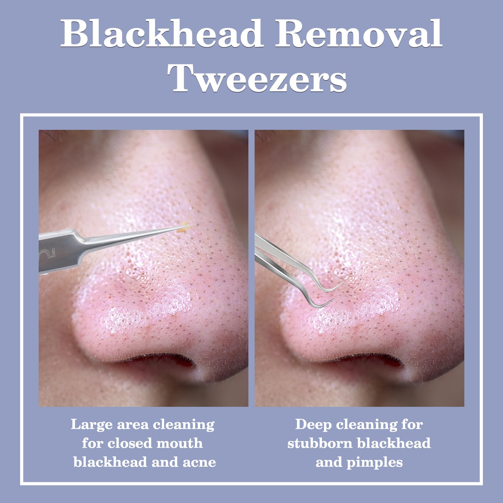 Wsyub Blackhead Tweezers,Ingrown Hair Tweezers,Pimple Popper Tool Kit,Acne Needle Tool, Blackhead Extractor,Eyebrows Facial Hair