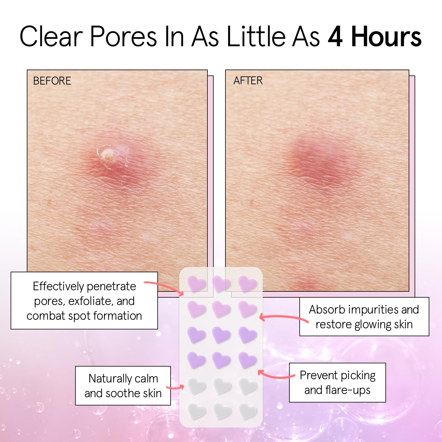 Grace & Stella Pimple Patches For Face (Heart, 36 Count) - Hydrocolloid Acne Patches For Face - Dermatologist Tested, Vegan, Cru