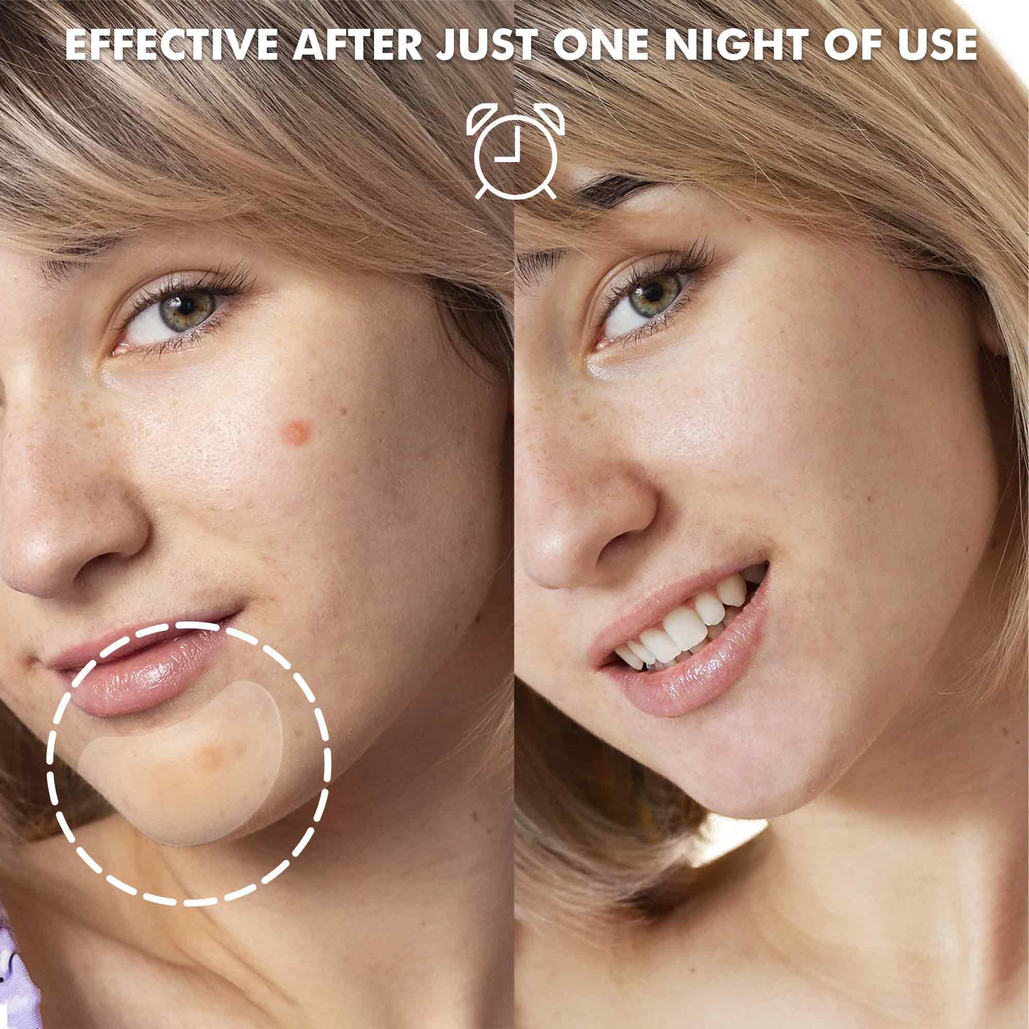 Large Acne Pimple Patches For Face, Chin, Back And Body (10 Counts), Spot Dots Cover By Albatross Health New England, Hydrocollo