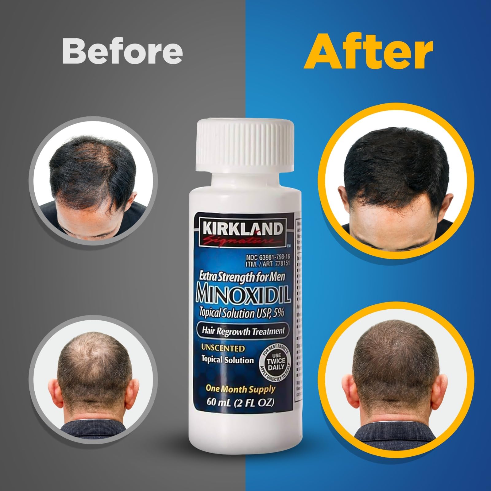Minoxidil For Men 5% Topical Solution Extra Strength Hair Regrowth Treatment, Dropper Applicator Included (6 Month Supply), Clea