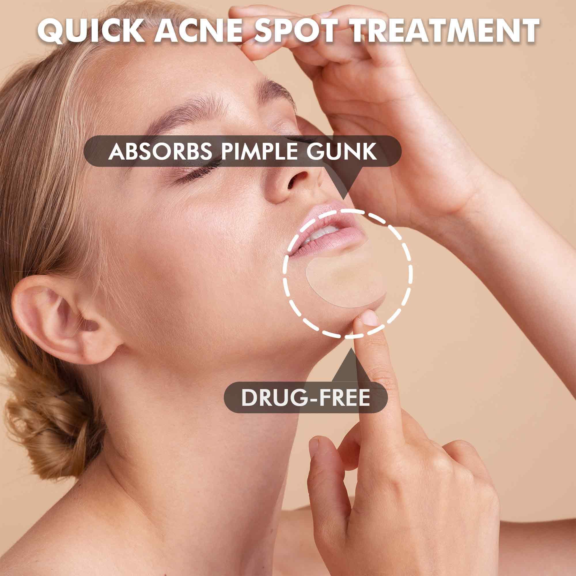 Large Acne Pimple Patches For Face, Chin, Back And Body (10 Counts), Spot Dots Cover By Albatross Health New England, Hydrocollo