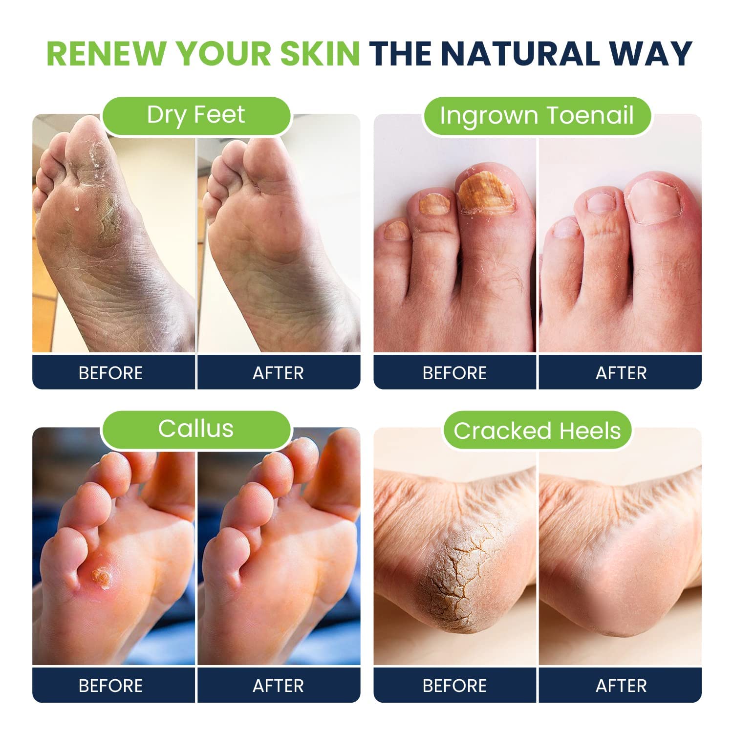Tea Tree Oil Foot Soak With Epsom Salt - For Toenail Repair, Athletes Foot, Softens Calluses, Soothes Sore & Tired Feet, Nail Di