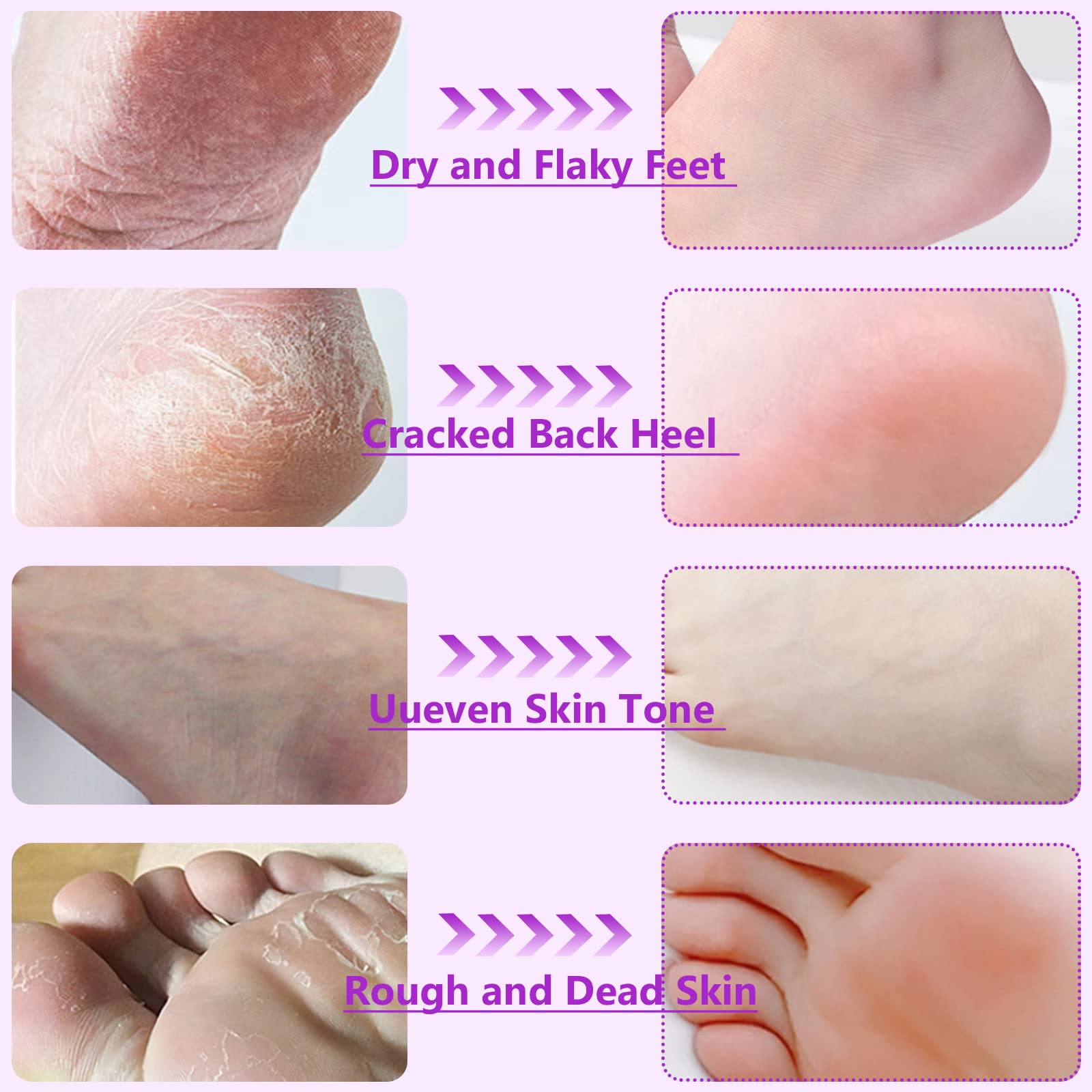 Permotary Foot Peel Mask - 6 Pack - Original Exfoliant Foot Peel - Feet Callus Remover & Dead Skin Remover, Moisturizing Feet, B