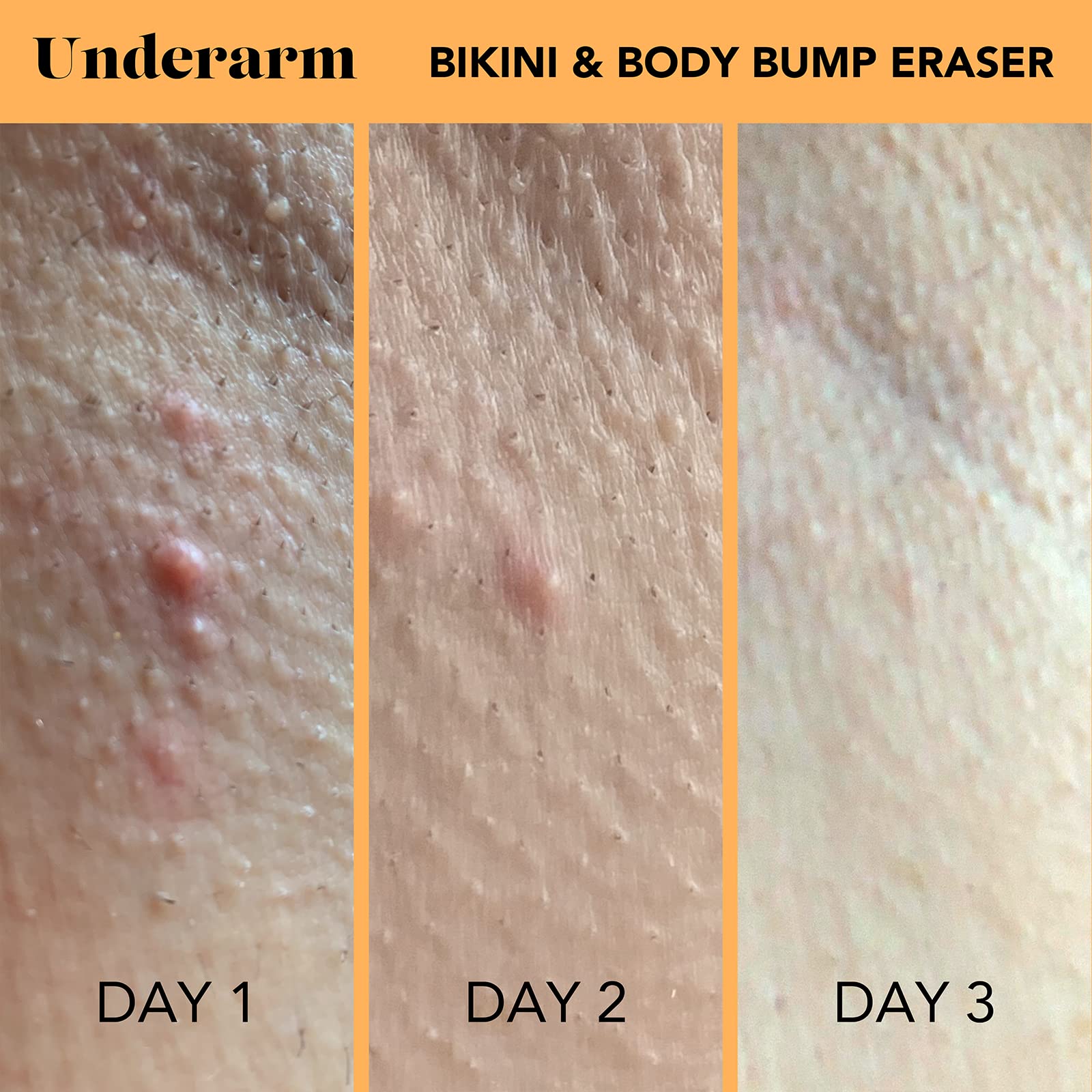Sweetspot Labs Bikini & Body Bump Eraser | Treat Razor Bumps & Dark Spots | With Essential Ingredients Niacinamide & Bentonite C