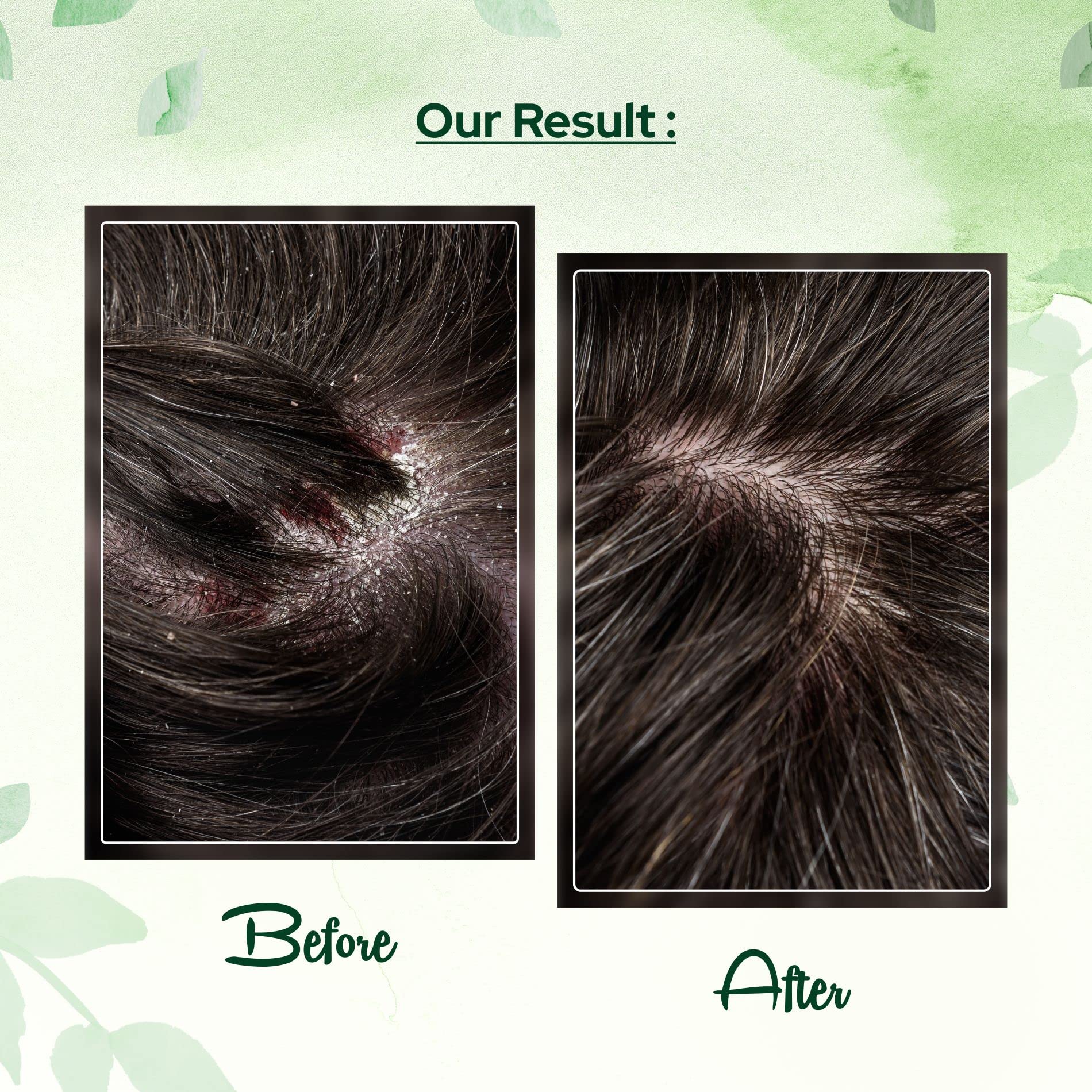 Cosalic Coal Tar And Salicylic Acid Solution/With Salicylic Acid For Dry Scalp Itch Relief Dandruff Free Shampoo/For Psoriasis &