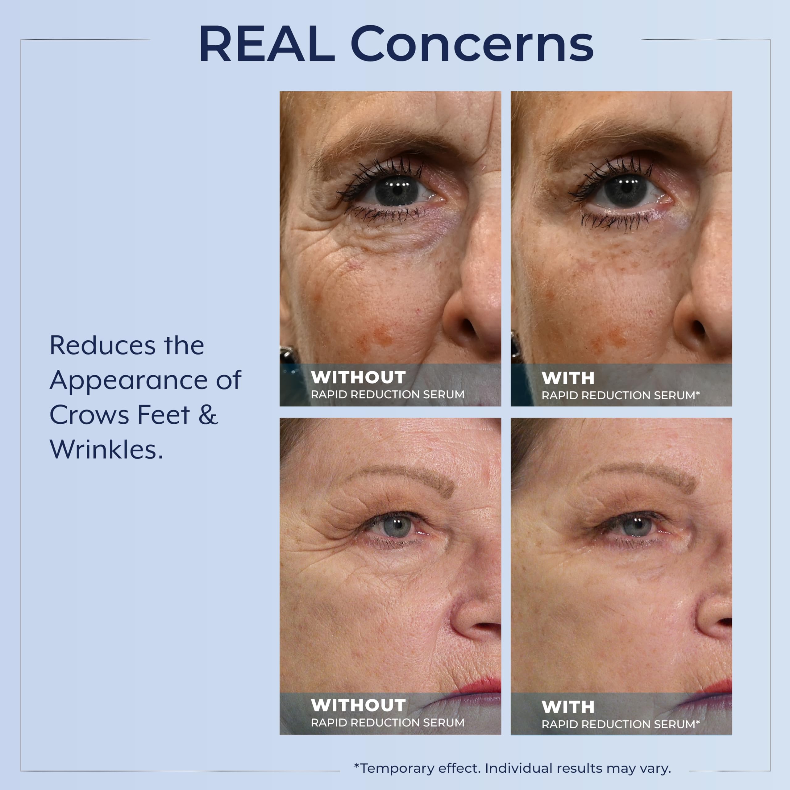 Plexaderm Rapid Reduction Eye Serum - 0.17 Fl Oz, Reduces Under-Eye Bags, Dark Circles, Wrinkles & Fine Lines Instantly, Anti-Aging Remover