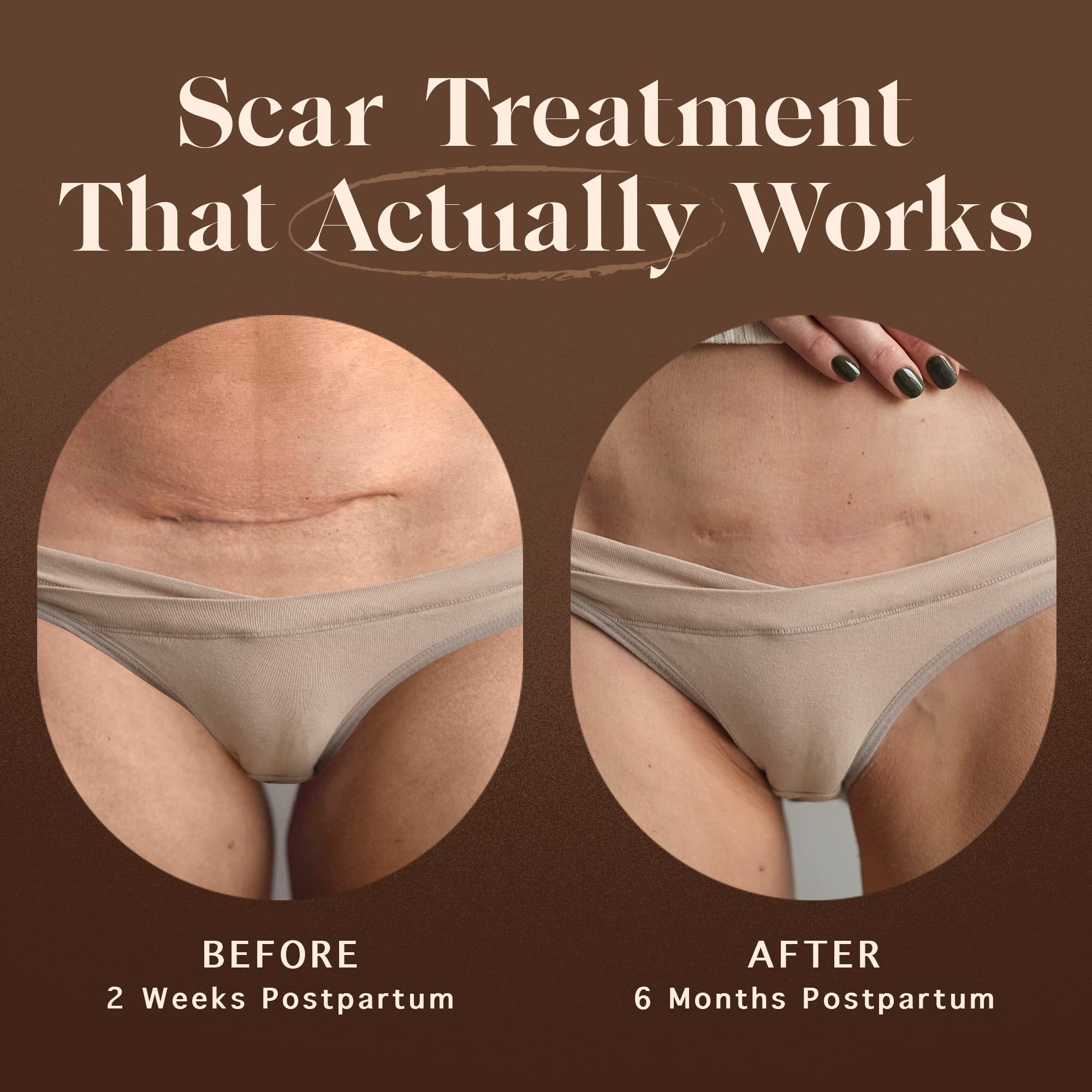 Nemah - Restorative Scar Treatment - C Section Scar Treatment For Postpartum Scar - Dual-Action Maternity C Section Scar Cream &