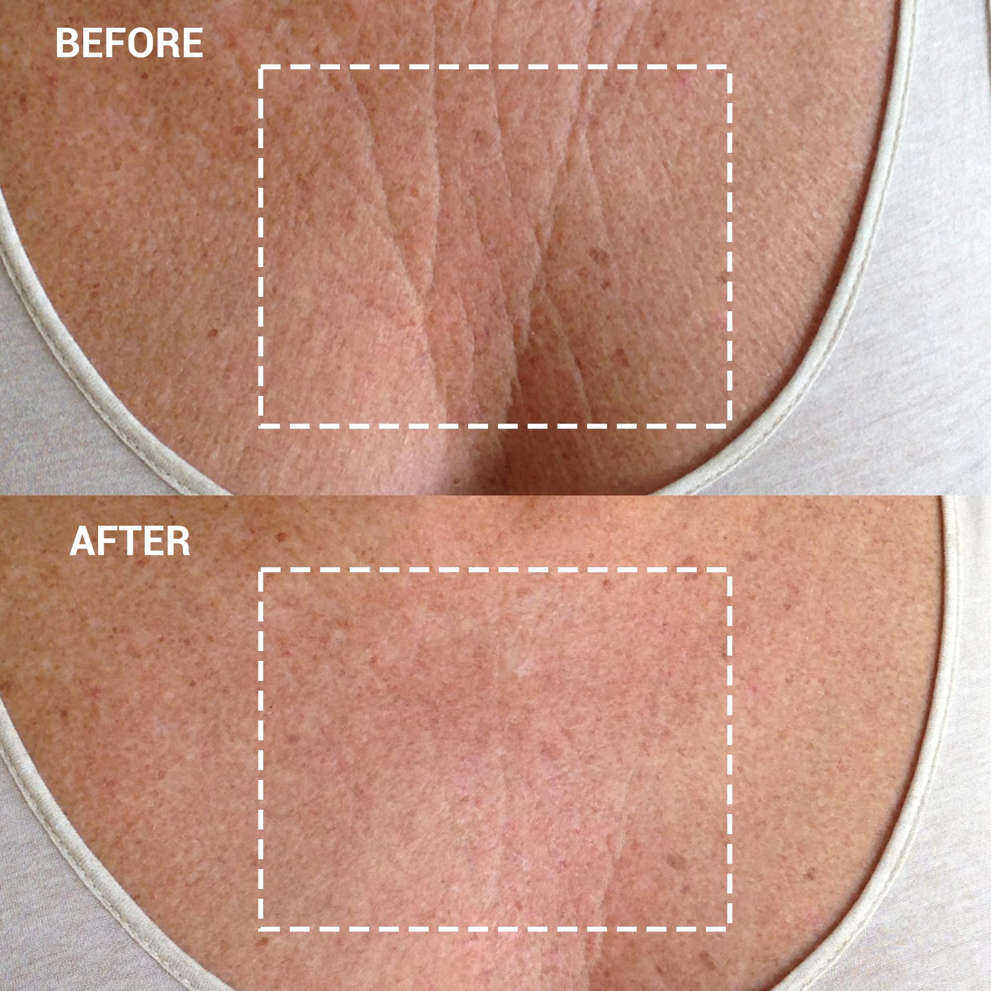 Wrinkles Schminkles Chest Wrinkle Patch - Reusable Silicone Smoothing Pads for Cleavage & Body, Reduce Wrinkles & Stretch Marks,